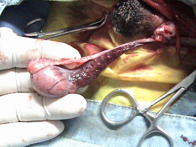 Se extrae el primer testículo